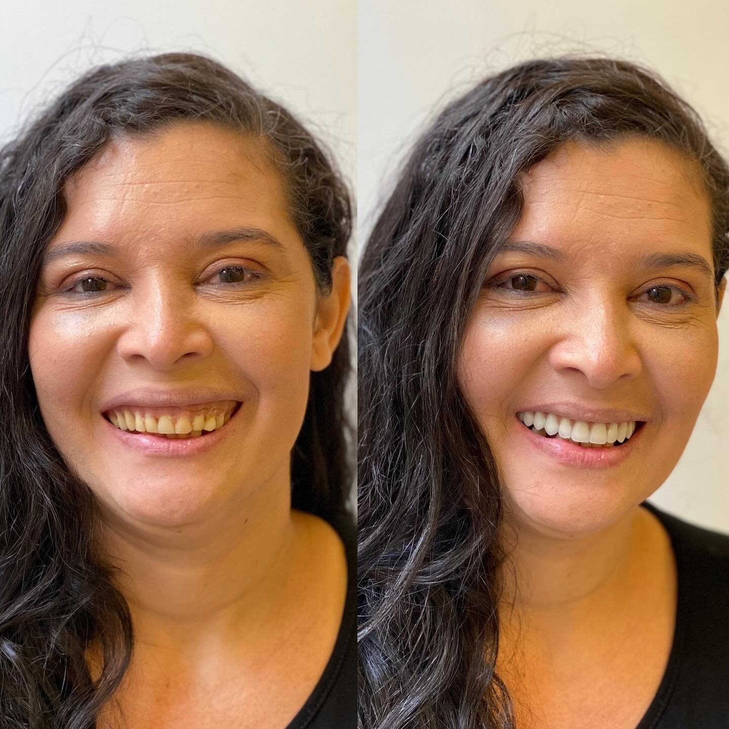 Estética Dental